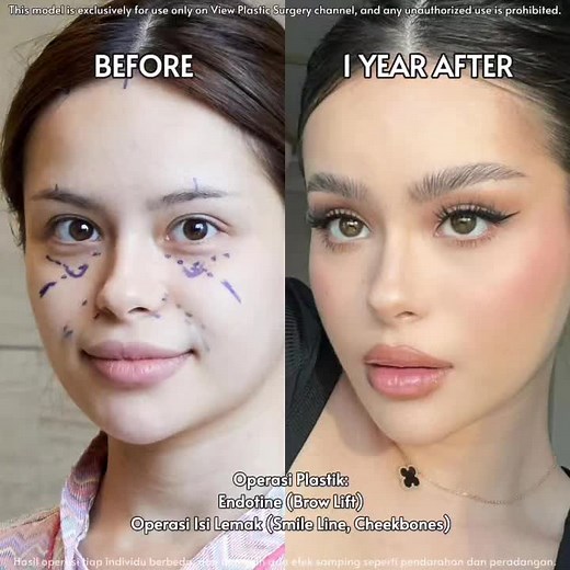 Hayley Bui Brow Lift & Fat Graft: Before & After | View Plastic Surgery