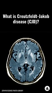 Creutzfeldt-Jakob disease is a prion disease characterized by progressive deterioration of mental function, leading to dementia, involuntary jerking of muscles (myoclonus), and staggering when walking. A variant form is acquired by eating contaminated beef. There is no cure. Learn more: https://mrkmnls.co/4lLtVdw | Merck Manual Consumer