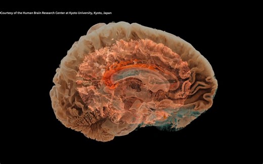MRI explained: How does it work?