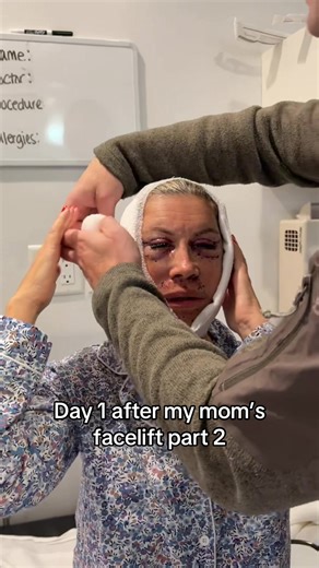 Mom's Facelift Recovery: Day 1 Insights