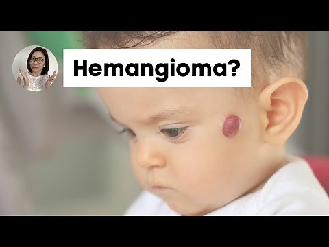 Hemangioma in Children: Info for Parents | Dr. Kristine Alba Kiat