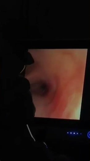 Bronchoscopy Explained | Bronchoscopy Procedure Step by Step | ICU & Pulmonary Guide