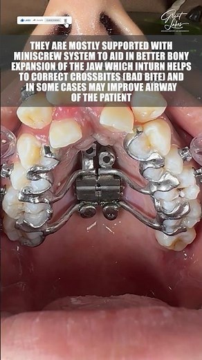 Customised 3D Printed Mini-Screw Supported Jaw Expander | Jaw Expansion in Adults | MSE | MARPE