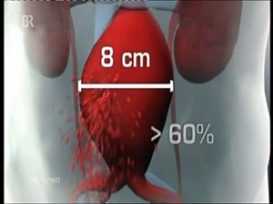 BR Gesundheit "Aortenaneurysma"