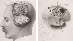 Language Mapping for Glioma | Cohen Collection | Volumes | The Neurosurgical Atlas