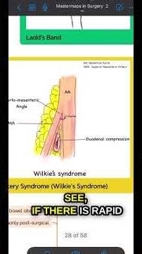 Superior Mesenteric Artery Syndrome | #surgeryeducation #mbbs