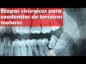 Surgical steps for third molar extractions | Dentistry | Dr. Bianca Rosa