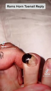 35K views · 209 reactions | Do you need a solution for a #ramshorntoenail ? Here it is :) #solutionstoproblems #learnwithlori #meticulousmanicurist #pedicure #nailtech #nailtechtraining | The Meticulous Manicurist Nail Tutorials | Facebook