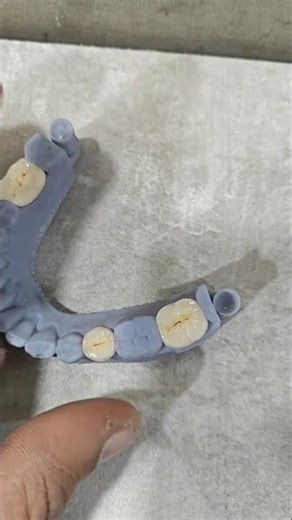 Cat cam crown" likely refers to CAD/CAM crowns, which are dental restorations created