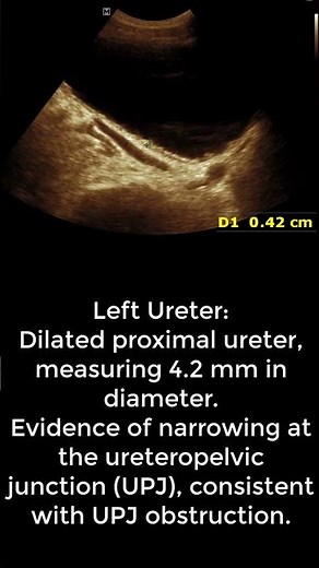 Bilateral UPJ Obstruction on Ultrasound | Signs, Remedies & When to See a Doctor