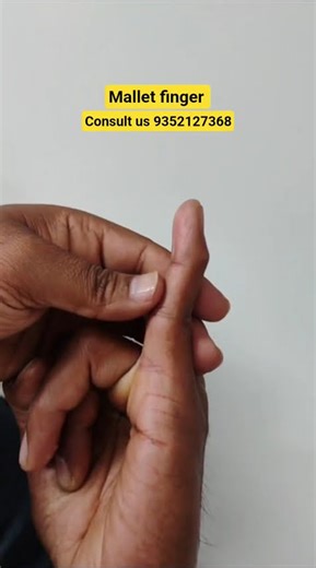 mallet finger #physiotherapy #stiffness #finger #thumb #splint #postoperative #wax #tendon #ruhs