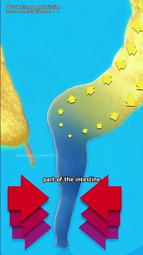 Congenital Megacolon (Hirschsprung's Disease) Explained (3D Animation)#congenitalmegacolon