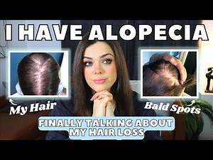 I Have Alopecia | Going Bald As a Woman | My Story With Pictures