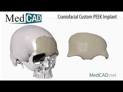 Craniofacial Custom PEEK Implant