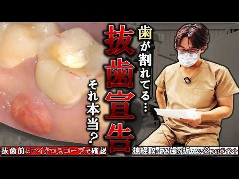 [Told to extract a cracked tooth] Using a microscope before extraction: 2 tips to prevent tooth f...