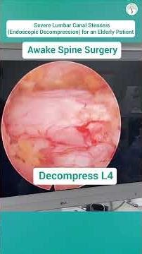 Awake Spine Surgery for Lumbar Stenosis — Safe, Fast Recovery for Elderly Patients! #spinecare