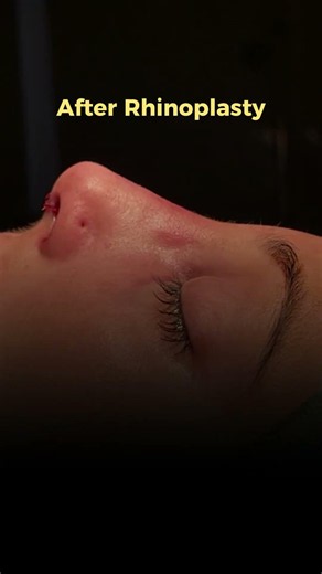 Natural Beauty, Refined Perfectly 💫 | Rhinoplasty by Dr. Salman