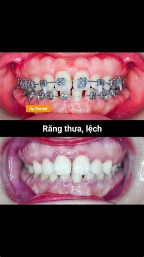 [Cận cảnh 224] Tiến trình niềng răng sau 2 năm
