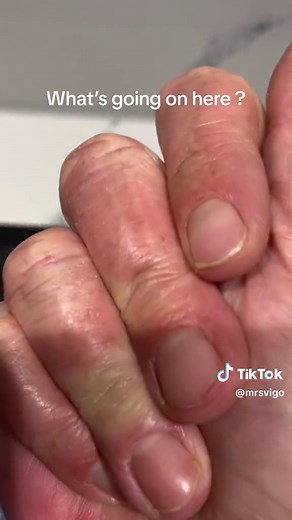 Can someone help me with the reddness of my hands especially on the sides of my palm please #doctorsoftiktok #doctor #naturopathicmedicine #naturopathicdoctor #redpalms
