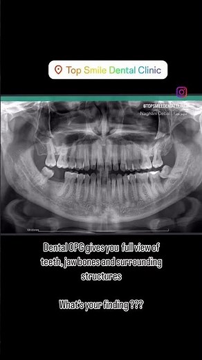 ✨ Why You Need a Dental OPG X-Ray! ✨A panoramic dental X-ray (OPG) gives a full view of your teeth,