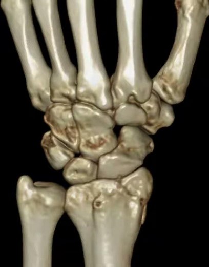 Distal radius fracture- Chauffeur's fracture