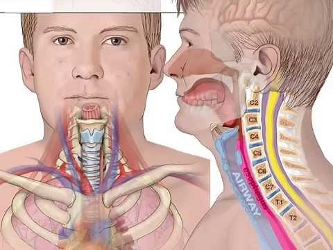 Complications of ACDF | Hematoma Formation | Airway Obstruction | Colorado Spine Surgeon