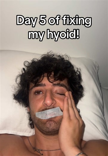 Understanding Hyoid Bone Changes for Better Looks