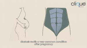 29K views | In this video, Dr Hannah shares her personal experience on how she managed her diastasis recti postpartum as well as some tips to heal well. If you are suffering from diastasis recti (or know someone is) fill in this form so we can contact you as a potential patient for clinical studies : https://forms.gle/9wPK6CWt4ZExjYAK9 | Clique Clinic | Facebook