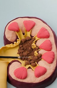 Kidney Stone Removal #fblifestyle | Crafty Gadgets