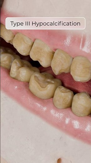 Amelogenesis Imperfecta: Genetic Enamel Disorders in 3D