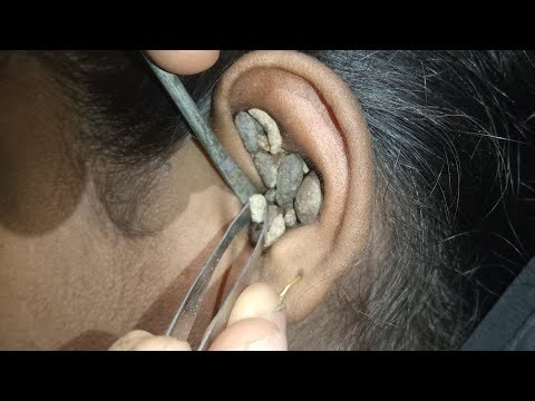 ,,Deep Ear Cleaning ASMR | Tingles Guaranteed 🔥