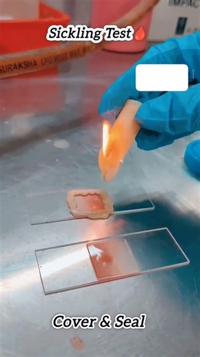 Sickling Test Procedure | Sodium Metabisulphite Method #shorts