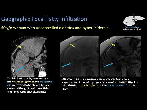 Hepatic Steatosis Part 2: Patterns of Steatosis