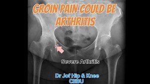 110 reactions · 16 comments | Persistent groin pain can be a...