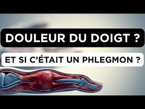 Flexor tendon sheath phlegmons: Diagnosis and management