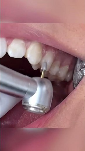 Removing Invisalign Attachments - How Are Attachments Removed - TheBracesDoc