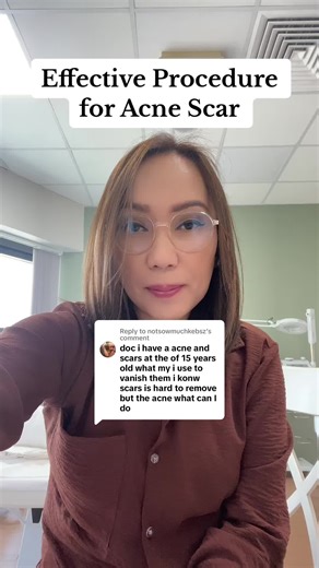 Invasive Treatments for Acne Scars Explained