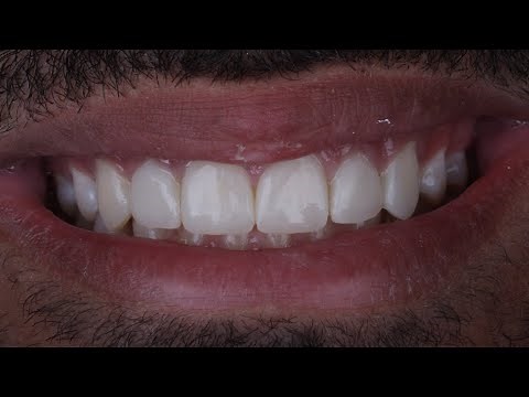 Anterior direct composite resin - layering of multiple teeth in one visit hands-on