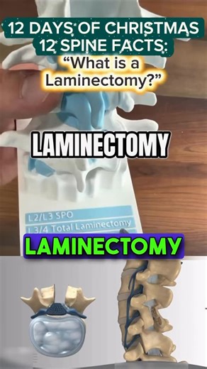 𝘾𝙝𝙚𝙨𝙩𝙚𝙧 𝙅 𝘿𝙤𝙣𝙣𝙖𝙡𝙡𝙮 𝙄𝙄𝙄, 𝙈𝘿 on Instagram: "Laminectomy is one of the most straightforward and effective ways to relieve pressure on a pinched nerve in the spine. In this quick breakdown, I explain what we remove, why we remove it, and how creating space around the nerve can lead to real symptom improvement — sometimes immediately. Whether you’re hearing this term for the first time or you’ve been told you might need one, this video cuts through the jargon so you actually unde