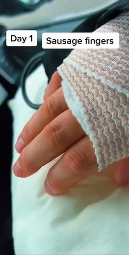 ECU tendon sheath reconstruction. Finger swelling progress