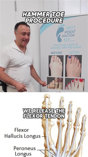 Say Goodbye to Hammer toe with Minimally Invasive Surgery! 🦶 Hammer toe can be painful and affect your mobility, but you don’t have to live with it. At Best Foot Doctor NY, we offer minimally invasive hammertoe correction surgery to help you get back on your feet—comfortably! ✅ Quick recovery ✅ Minimal scarring ✅ Improved mobility 👣 Don’t let hammer toe hold you back. Schedule your consultation today and take the first step toward pain-free feet! #HammertoeSurgery #HealthyFeet #PodiatryCare #B