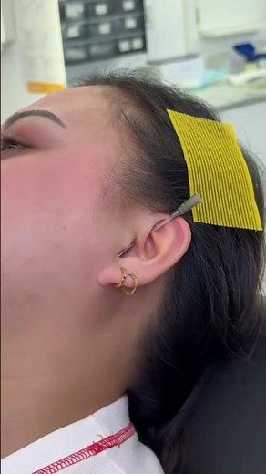 Master Your Daith Piercing: From Procedure to Perfect Healing #daithpiercing #helixpiercing