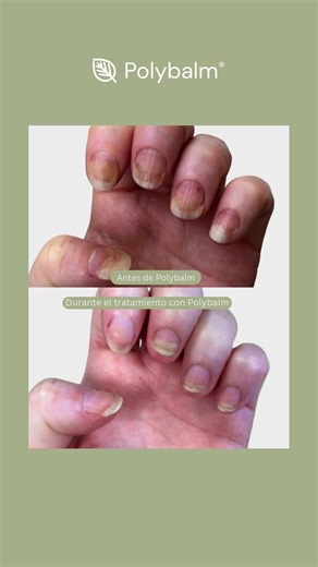 Muchas personas no saben que la quimioterapia también puede afectar las uñas… y cuando pasa, puede doler más de lo que imaginan. La sensibilidad, la fragilidad y el daño ungueal no son solo un tema estético: impactan la comodidad diaria y la calidad de vida. Acompañar la uña mientras crece puede marcar una gran diferencia en cómo se vive el tratamiento. Si estás atravesando este proceso o acompañas a alguien con cáncer, no tienes que normalizar el dolor en las uñas. Escríbenos por mensaje direct