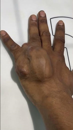 Can You Diagnose This Hand Swelling? #shorts
