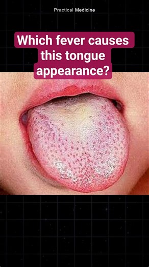 Raspberry/Strawberry tongue is found in #mcq #diagnosis #spotdiagnosis