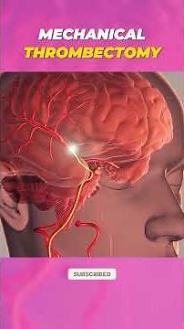 Mechanical Thrombectomy Explained | 3D Animation #Thrombectomy #stroketreatment #medicalshorts