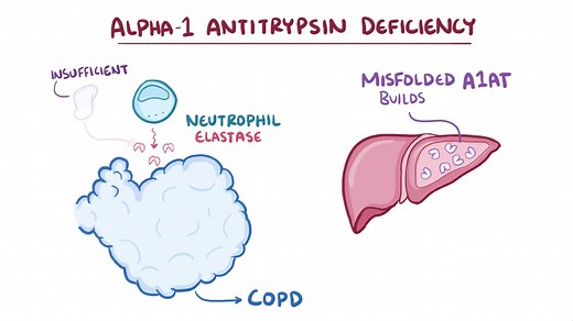 Alpha-1 Antitrypsing Deficiency - How It Works