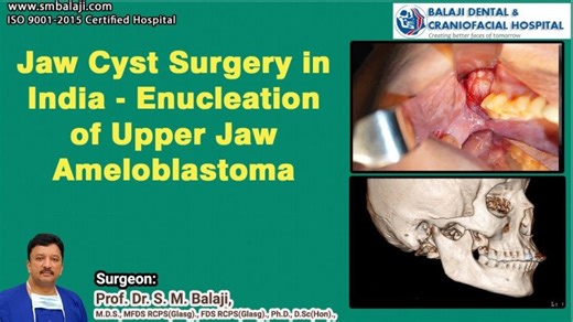 Jaw Cyst Surgery in India - Enucleation of Upper Jaw Ameloblastoma