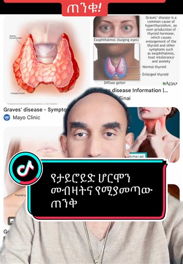 Understanding Hyperthyroidism and Its Symptoms