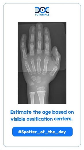 Spotter of the Day: Estimating Age Based on Ossification Centers | Medical Challenge